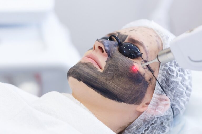 Process of photothermolysis, warming the skin, laser carbon peeling